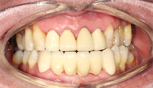 4 Upper Anterior Crowns and 6 units Lower Anterior Bridge | Dental Blog