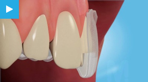 how teeth whitening works
