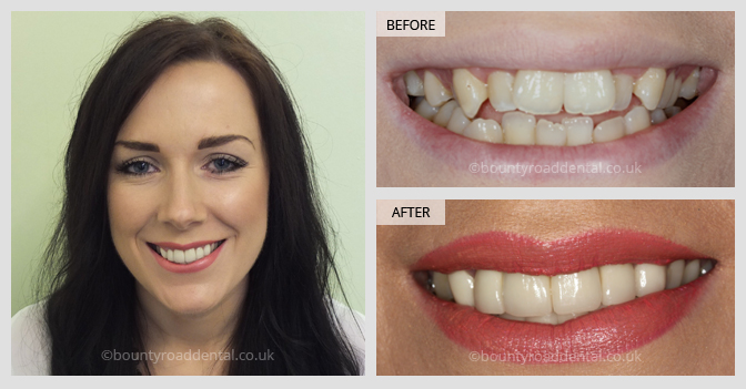 Crowns and Veneers