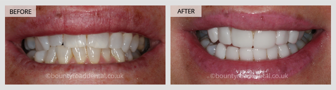 before and after dental veneers