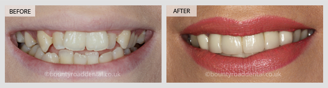 before and after veneers