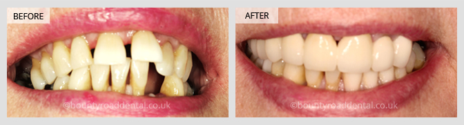 smile makeover and dental implant