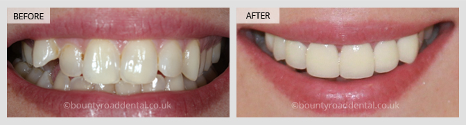 before and after veneers