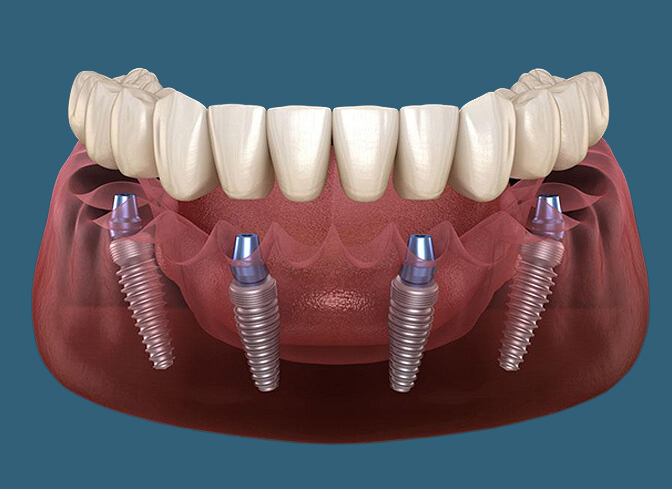 Teeth In A Day