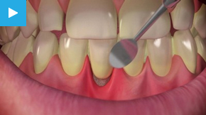 Sensitive Teeth Treatment