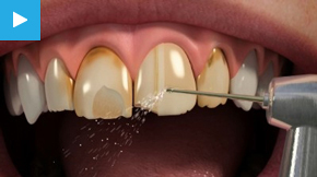 Dental Veneers, Crowns and Bridges