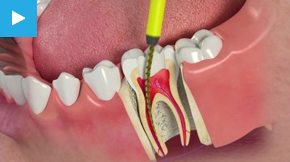 Root Canal Treatment in Basingstoke
