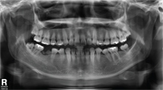CT Scan