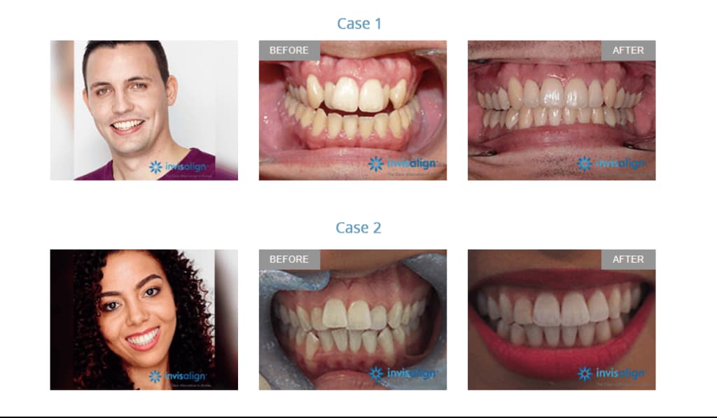 Aligners case study before and after results