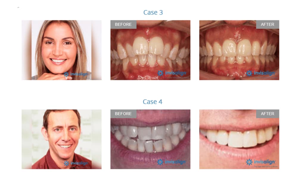 Invisalign before and after results