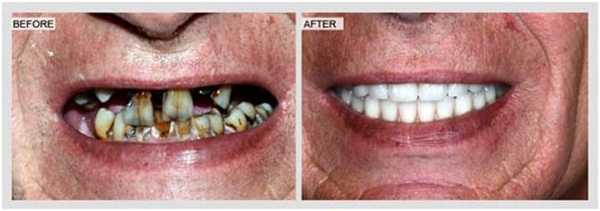 before and after teeth in a day and whitening