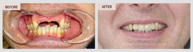 before and after dental implants - showing missing teeth replaced