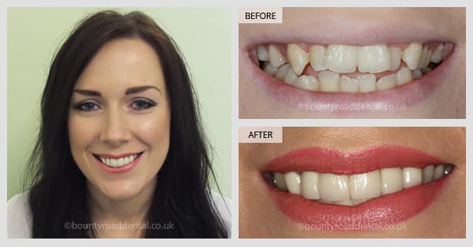 crowns and veneers before and after