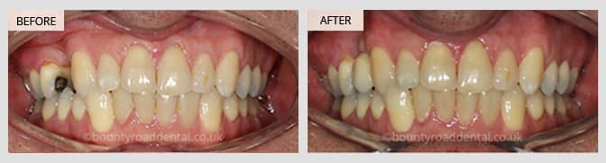 before and after single dental implant results