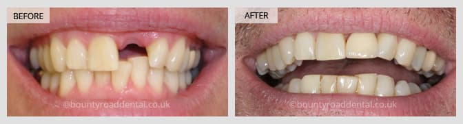 single front tooth before and after dental implant result