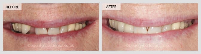 before and after dental implants