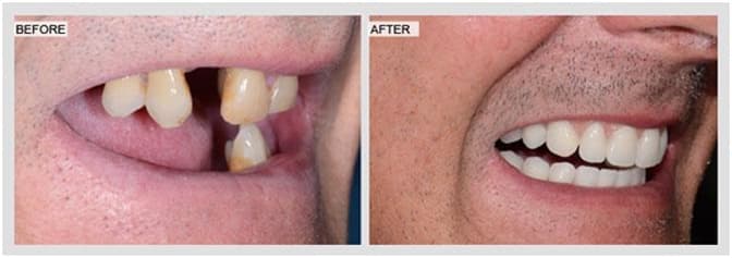 before and after teeth in a day
