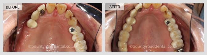 before and after dental implant result