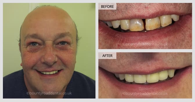 before and after crown and bridge transformation