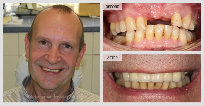 bridge before and after fixing missing teeth