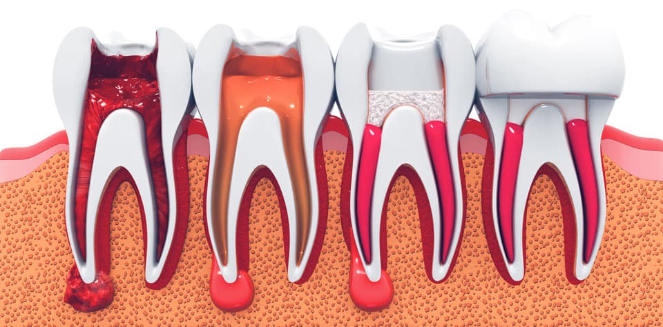 root canal treatment basingstoke