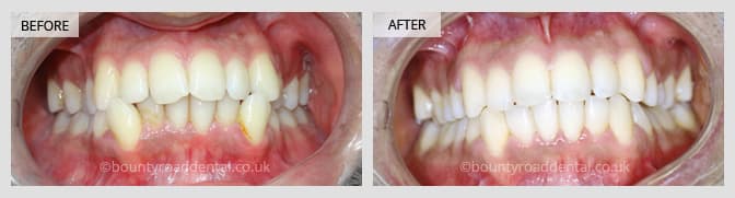 6-month smile transformation