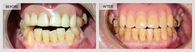 Six-month smile transformation