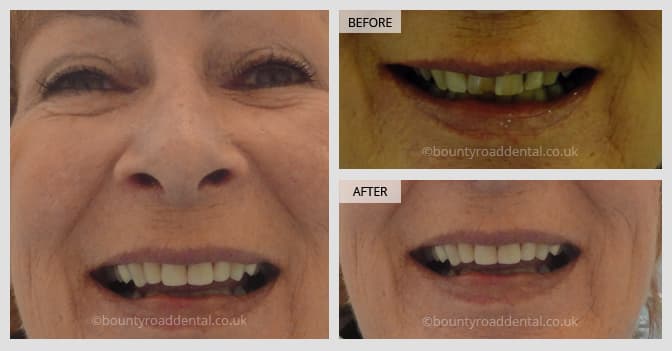 smile transformation