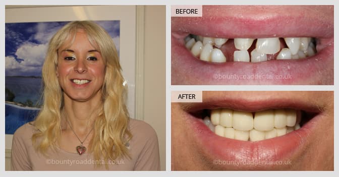 teeth alignment transformation in Basingstoke