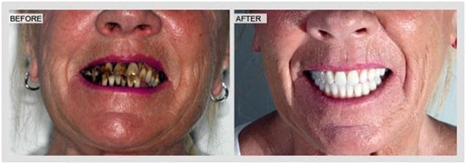 teeth in a day whitening on all