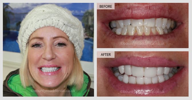 teeth whitening and straightening 