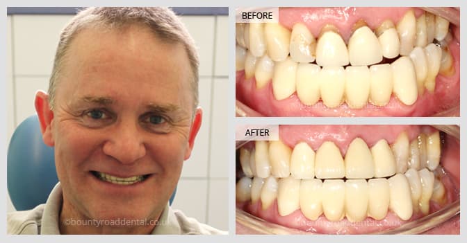 Transforming your smile with bridges and crowns